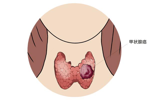 甲狀腺癌癥的主要癥狀表現(xiàn)有什么？為什么會(huì)得甲狀腺癌癥呢？