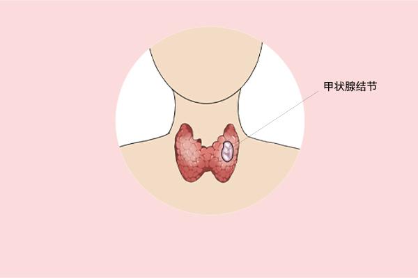 甲狀腺癌癥的主要癥狀表現(xiàn)有什么？為什么會(huì)得甲狀腺癌癥呢？