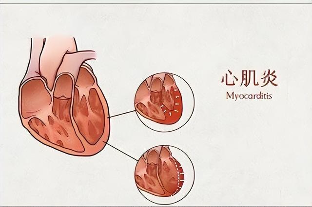 心肌炎的癥狀有哪些？心肌炎的主要變現(xiàn)癥狀有啥？